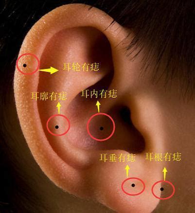 耳內有痣|耳朵痣位置：影響健康？